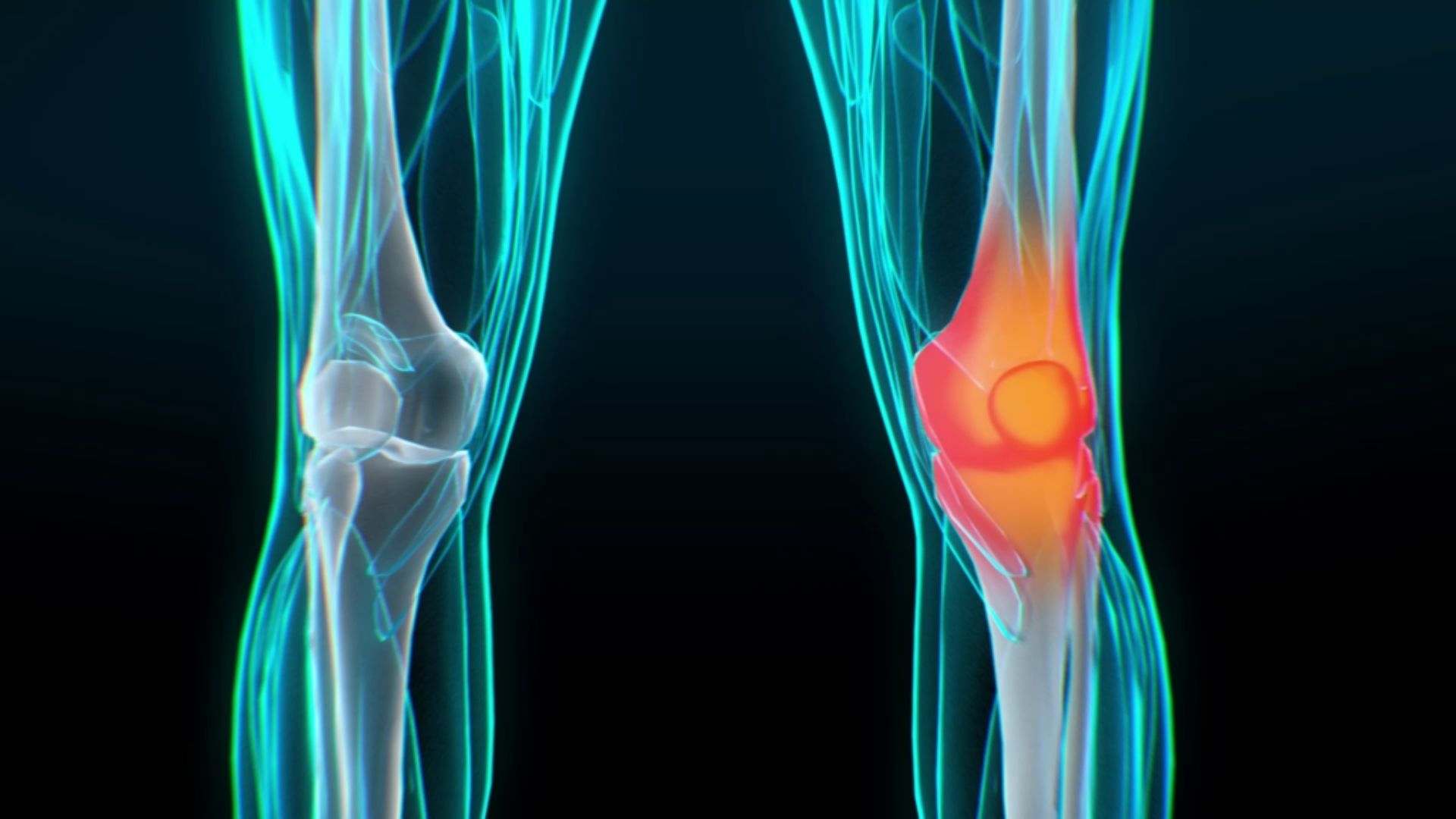 Inflammation of the knee - Explainer Video by Darvideo