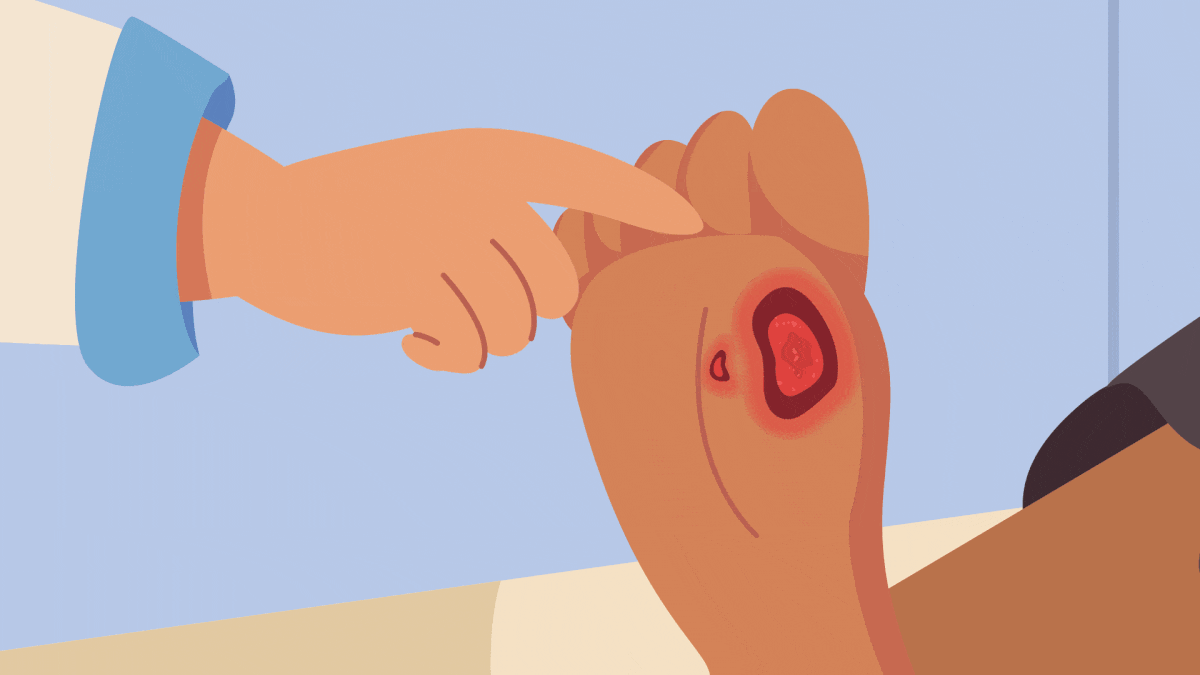 A doctor pointing at an open wound on a patient’s foot